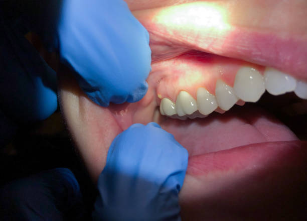 Best Emergency Dentist for Knocked-Out Tooth in Frazeysburg, OH